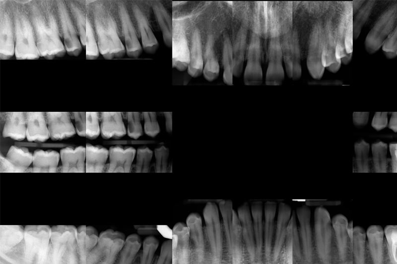 Digital Dental X Rays in Lone Tree, CO