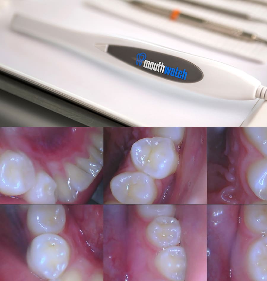 Mouth Watch Intra Oral Camera at Lone Tree Dental Office