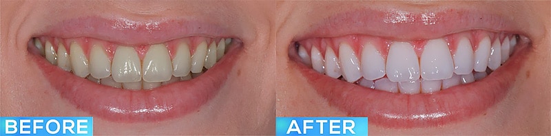 Teeth Whitening in Lone Tree, CO Before and After