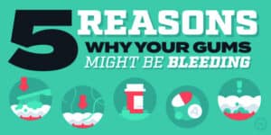 5 Reasons Why Your Gums Might be bleeding