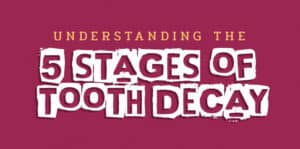 understanding 5 stages of tooth decay