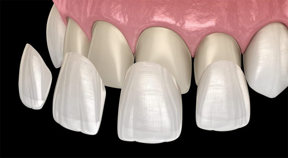 Dental Veneers in Lone Tree, CO