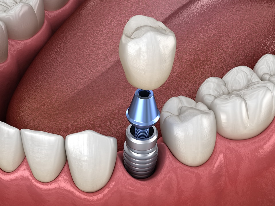 dental implants for perfect teeth